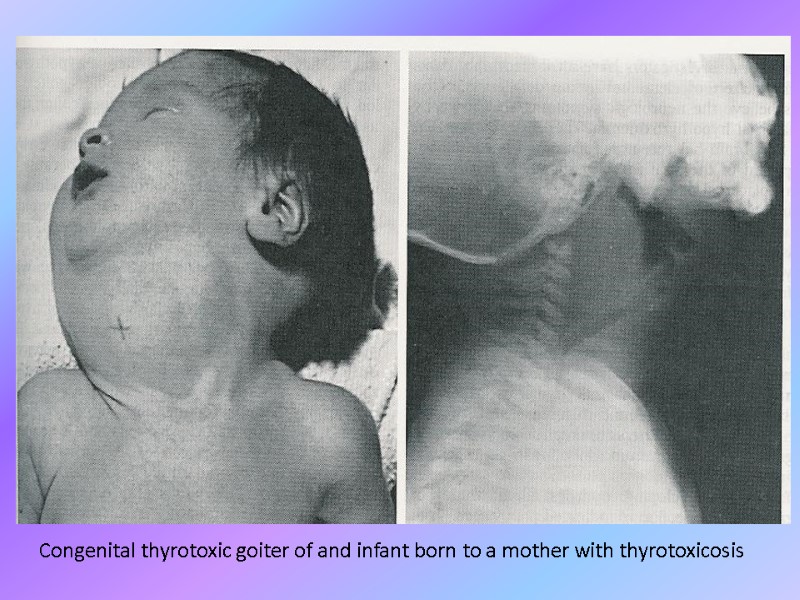 Congenital thyrotoxic goiter of and infant born to a mother with thyrotoxicosis